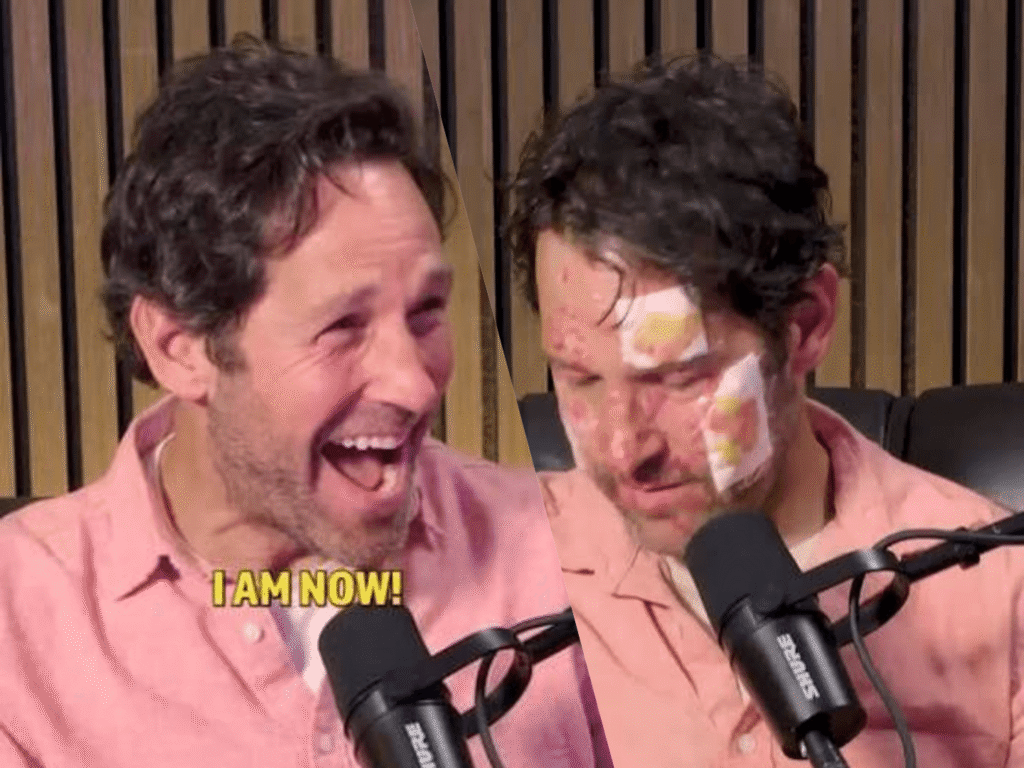 Paul Rudd Burns: What Happened and the Truth Explained